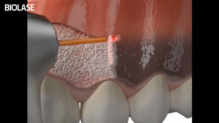 GUM DEPIGMENTATION