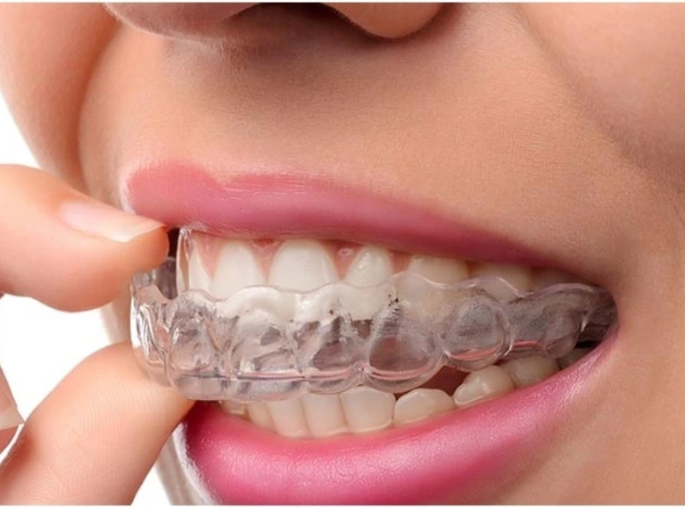 DENTAL BRACES AND ALIGNERS