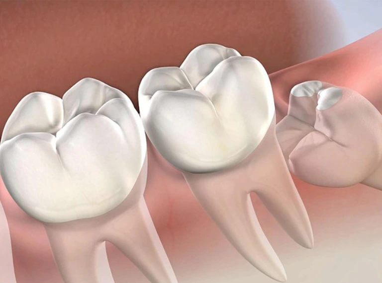 WISDOM TOOTH EXTRACTION