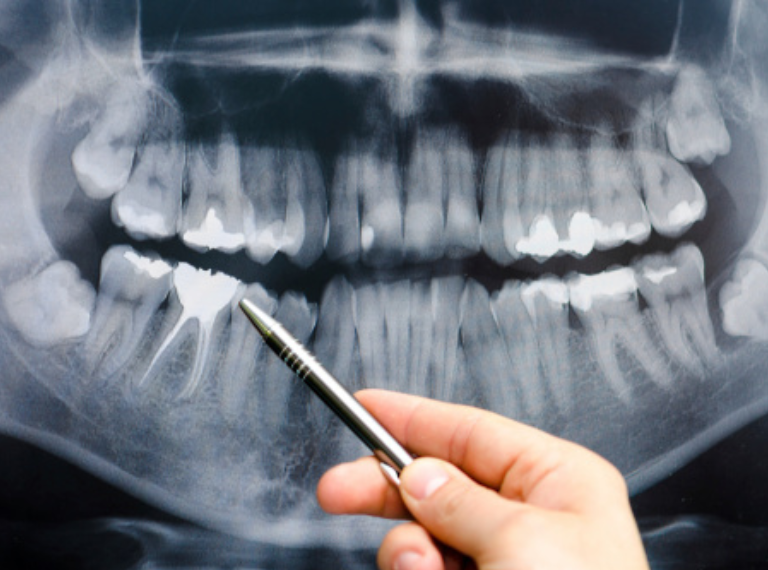 DENTAL XRAYS