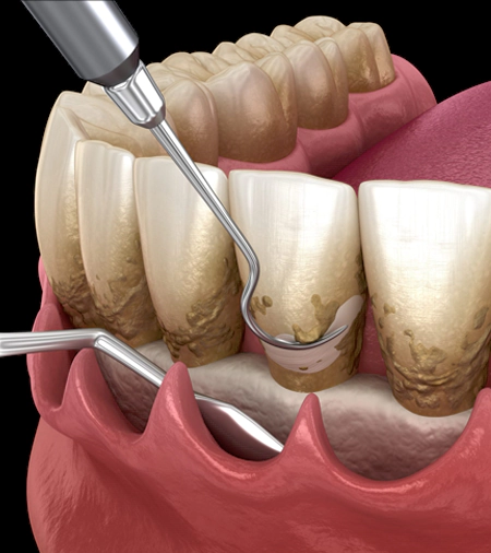 PERIODONTAL FLAP SURGERIES