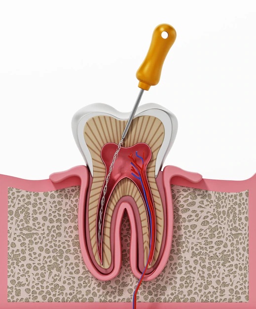 ROOT CANALS